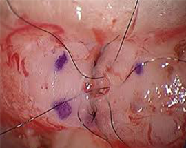 Vasectomy and Vasectomy Reversal